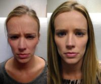 34 year old woman treated with Botox