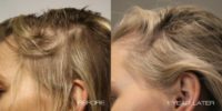 25-34 year old woman treated with Hair Loss Treatment, PRP for Hair Loss
