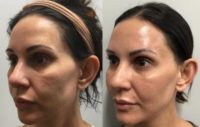 35-44 year old woman treated with Halo Laser