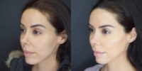 37 year old woman treated with Injectable Fillers - cheeks contouring, jaw line definition and lips