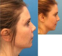 37 year old woman treated with Laser Peel
