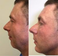 35-44 year old man with chin augmentation using injectable filler