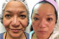 35-44 year old woman treated with Non Surgical Face Lift
