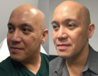 35-44 year old man treated with Microneedling