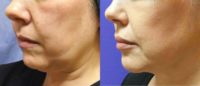 35-44 year old woman treated with Kybella