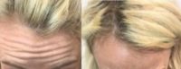 35-44 year old woman treated with Botox in Forehead