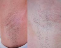 35-44 year old woman treated with Laser Hair Removal, Skin Lightening