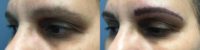 35-44 year old woman treated with Microblading