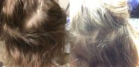35-44 year old woman treated with PRP Hair Restoration