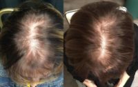 45-54 year old woman treated with PRP for Hair Loss