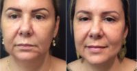 45-54 year old woman treated with Ultherapy