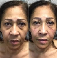 45-54 year old woman treated with Restylane Lyft