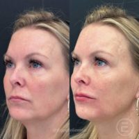 45-54 year old woman treated with Lip Fillers, Dermal Fillers, Restylane Kysse