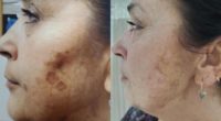 45-54 year old woman treated with Age Spots Treatment