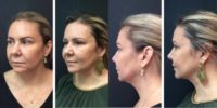 45-54 year old woman treated with Ultherapy ( Lower face)