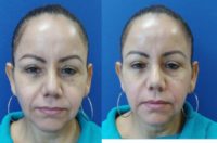 45-54 year old woman treated with Restylane Defyne