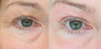45-54 year old woman treated with Fractional Laser - Madonna Eye Lift
