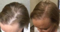 45-54 year old woman treated with PRP for Hair Loss