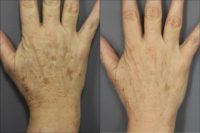 55-64 year old woman treated with Fraxel Laser
