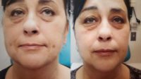 55-64 year old woman treated with Age Spots Treatment