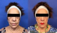 55-64 year old woman treated with Halo Laser