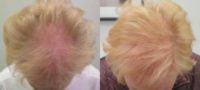 55-64 year old woman treated with The Activator hair loss treatment