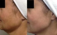 55-64 year old woman treated with Laser Treatment