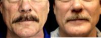 55-64 year old man treated with Injectable Fillers