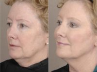 55-64 year old woman treated with Cheek Augmentation