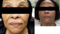 55-64 year old woman treated with Radiesse