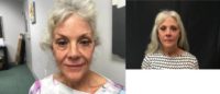 65-74 year old woman treated with Injectable Fillers