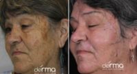 65-74 year old woman treated with Age Spots Treatment