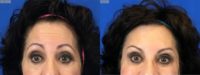 65-74 year old woman treated with Botox