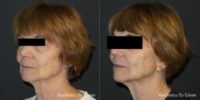 75-84 Year Old Woman treated with Injectable Fillers