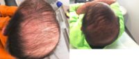 75 and up year old man treated with PRP for Hair Loss