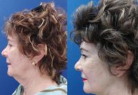 77 year old woman treated with Non Surgical Neck Lift