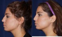25-34 year old woman treated with Juvederm to nose