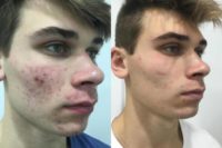 18-24 year old man treated with Halo Laser