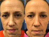 37 year old woman treated with Botox
