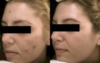 Woman treated with Fraxel Laser