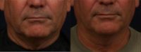 Man treated with Ultherapy Skin Tightening