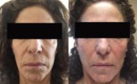 67- year-old woman treated with Sculptra