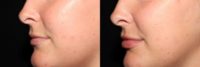 25-34 year old woman treated with Lip Fillers
