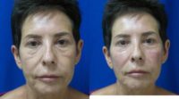 55-64 year old woman treated with Nonsurgical Cheek Augmentation