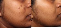 35-44 year old woman treated with PicoWay, for post inflammatory pigmentation