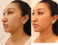 Woman treated with RHA Collection Fillers