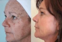 Woman treated with CO2 Laser