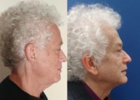 55-64 year old man treated with Nonsurgical Neck Lift