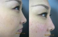 35-44 year old woman treated with Non Surgical Nose Job