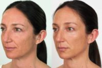 35-44 year old woman treated with Restylane Defyne and Restylane Refyne